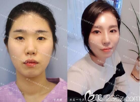 在韓國UcanB整形外科李芳碩做眼睛怎么樣