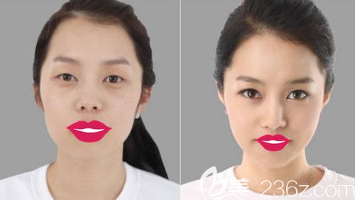 您有一份邯鄲麗人整形五月大禮包未開啟  里面有2380元的雙眼皮和假體隆鼻優(yōu)惠讓你擁有媚眼翹鼻