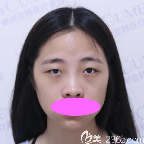 我沒去贛州亞韓整眼睛前的素顏照 我沒去贛州亞韓整眼睛前的素顏照