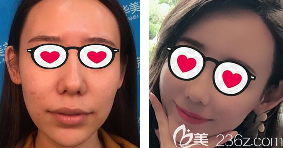 呼和浩特華美<!--<i data=20240703-sp></i>-->做全臉脂肪填充的效果怎么樣 呼和浩特華美<!--<i data=20240703-sp></i>-->做全臉脂肪填充的效果怎么樣