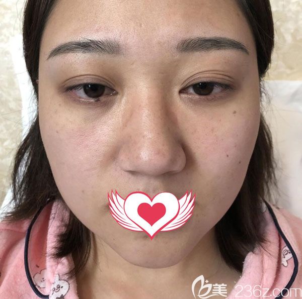 在昆明韓辰墊下巴手術(shù)前 在昆明韓辰墊下巴手術(shù)前