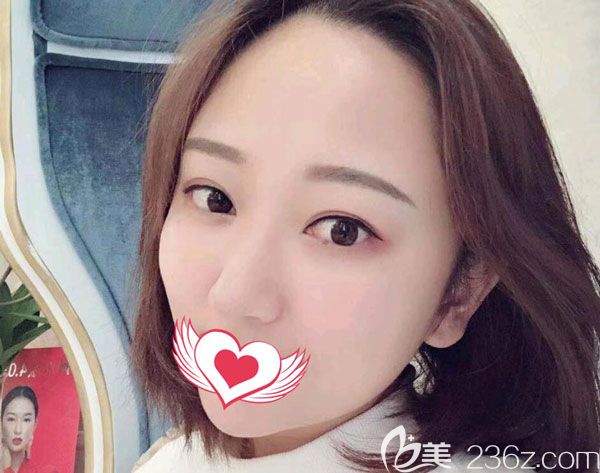 自體脂肪移植豐下巴第7天腫脹基本已經(jīng)消退 自體脂肪移植豐下巴第7天腫脹基本已經(jīng)消退