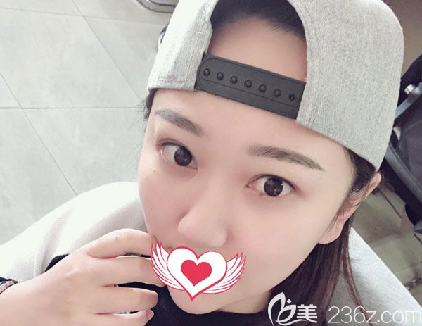 自體脂肪墊下巴一個(gè)月整張臉看起來圓潤(rùn)飽滿 自體脂肪墊下巴一個(gè)月整張臉看起來圓潤(rùn)飽滿