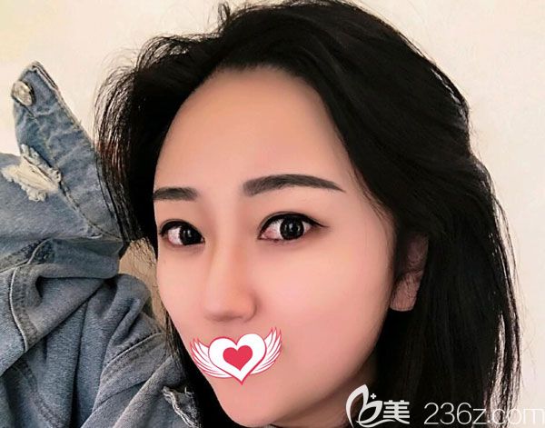 昆明自體脂肪墊下巴價(jià)格是多少？我找韓辰做自體脂肪豐下巴+蘋果肌花16000元就搞定了