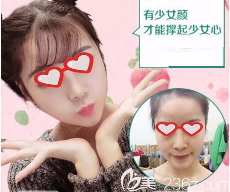 呼和浩特華美胡俊峰自體脂肪面部填充效果怎么樣