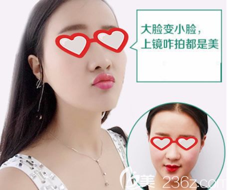 呼和浩特華美整形范志宏瘦臉除皺瘦臉前后效果對(duì)比照片