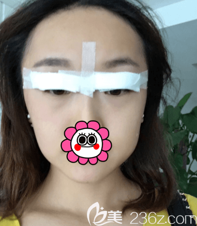 范憲紅醫(yī)生給我做埋線雙眼皮第2天樣子 范憲紅醫(yī)生給我做埋線雙眼皮第2天樣子