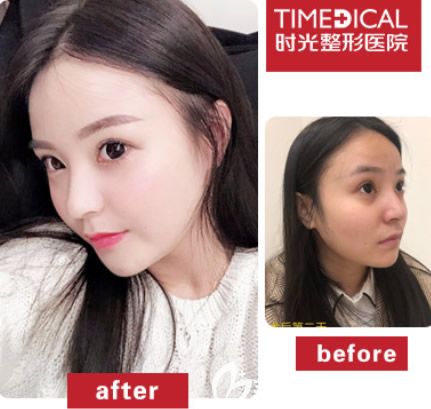 蘭州時光整形醫(yī)院注射前后效果對比圖
