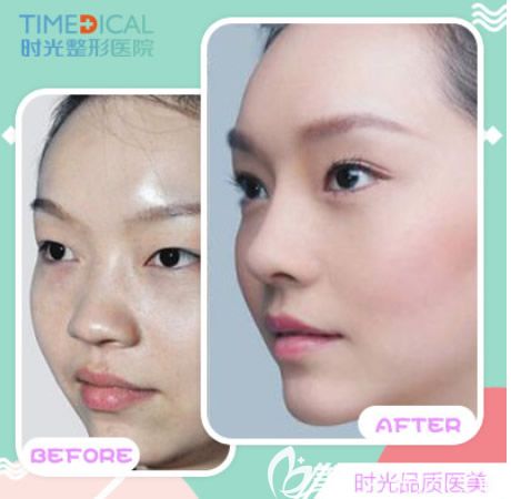 蘭州時光賈志蘭眼部綜合整形效果怎么樣