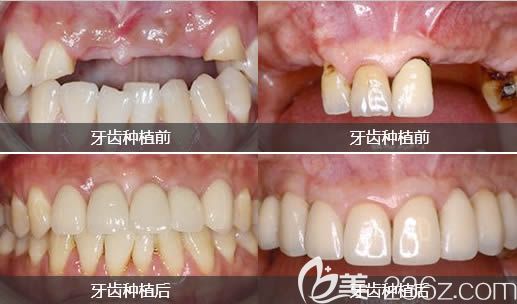 <!--<i data=20240703-sp></i>-->口腔牙齒種植前后對比圖
