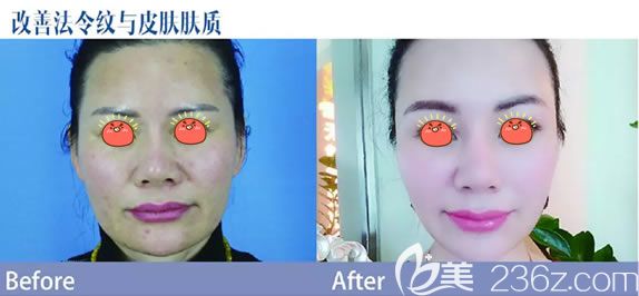金華麗都童顏針祛法令紋案例