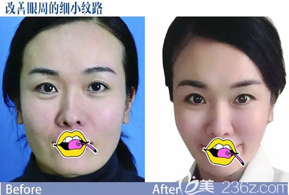 金華麗都童顏針眼周抗衰老案例