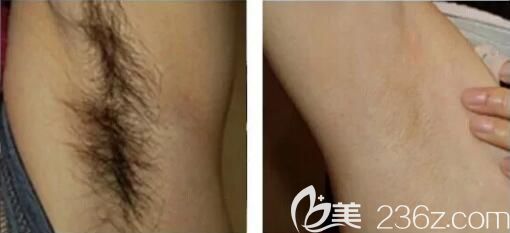 長(zhǎng)沙星雅萊西爾超冰脫腋毛真人前后效果對(duì)比圖