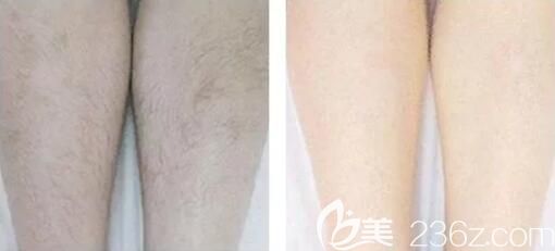 長(zhǎng)沙星雅萊西爾超冰脫腿毛前后效果對(duì)比圖