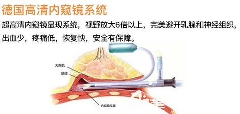 內(nèi)窺鏡隆胸的示意圖