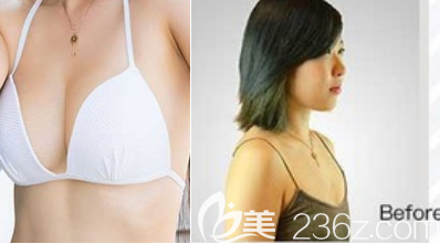 濟(jì)南隆胸案例