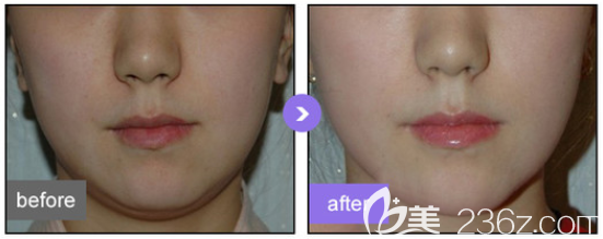 射頻溶脂瘦臉前后對比圖