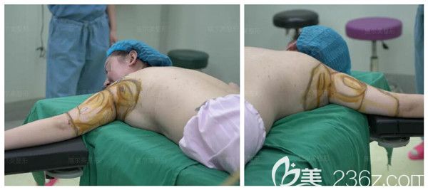 上臂環(huán)吸術(shù)前的劃線設(shè)計(jì) 上臂環(huán)吸術(shù)前的劃線設(shè)計(jì)