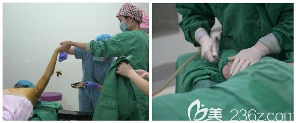 李彤彤醫(yī)生消毒后做吸脂手術(shù)中 李彤彤醫(yī)生消毒后做吸脂手術(shù)中