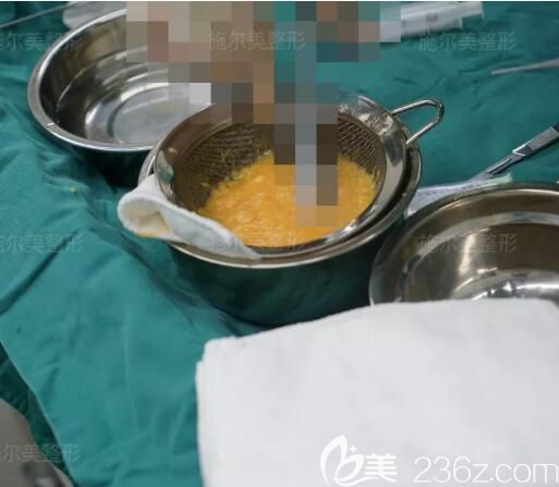 上臂環(huán)吸抽取出來的脂肪細(xì)胞 上臂環(huán)吸抽取出來的脂肪細(xì)胞