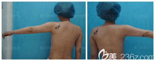 剛做完術(shù)后即刻上臂環(huán)吸效果展示 剛做完術(shù)后即刻上臂環(huán)吸效果展示