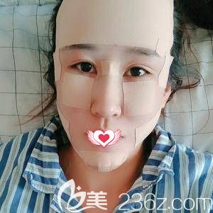 在石家莊天宏做脂肪填充面部術(shù)后面部腫脹 在石家莊天宏做脂肪填充面部術(shù)后面部腫脹