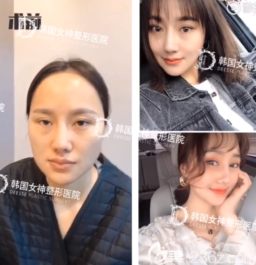 韓國女神醫(yī)院輪廓真人案例 韓國女神醫(yī)院輪廓真人案例