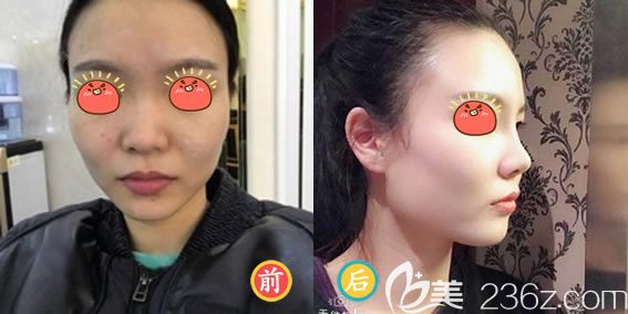 嘉興禾美美容醫(yī)院彭建隆鼻案例