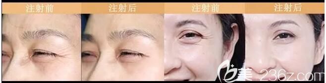 在南通康美做除皺前后對比 在南通康美做除皺前后對比