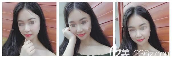 糾結(jié)后選擇南通儷人連天美醫(yī)生推薦線雕改善垮掉的臉和法令紋