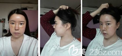 在韓國新帝瑞娜做眼鼻整形+面部輪廓手術(shù)后1周