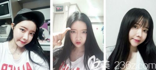 在韓國新帝瑞娜做眼鼻整形+面部輪廓手術(shù)后3個(gè)月