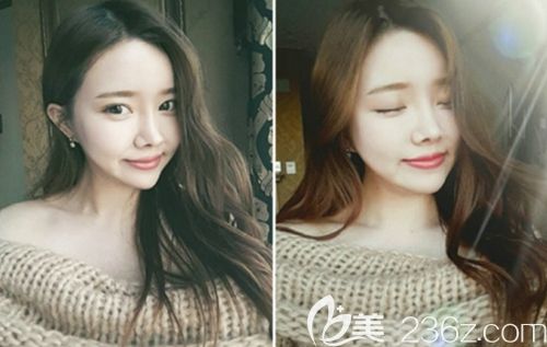 妹子天生臉大在韓國新帝瑞娜做眼鼻整形+面部輪廓+脂肪填充后3個月就解決了