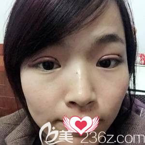 孫蘇寧醫(yī)生為我做雙眼皮術(shù)后第2天雙眼腫脹 孫蘇寧醫(yī)生為我做雙眼皮術(shù)后第2天雙眼腫脹