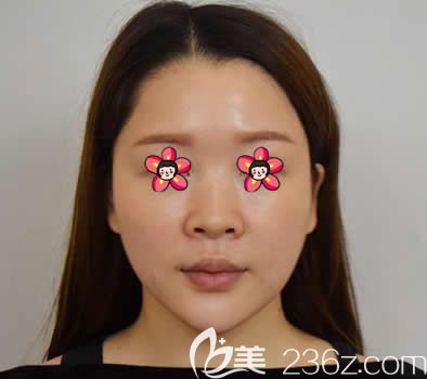 嘉興禾美醫(yī)院做硅膠隆鼻術前 嘉興禾美醫(yī)院做硅膠隆鼻術前