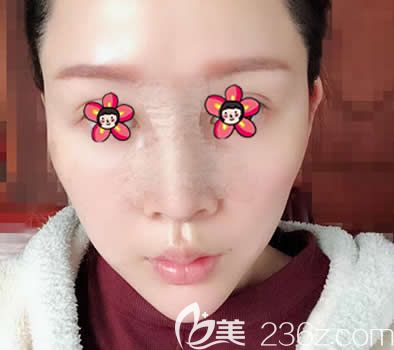 嘉興禾美整形曹海峰隆鼻案例即刻效果 嘉興禾美整形曹海峰隆鼻案例即刻效果