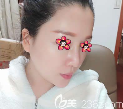 嘉興禾美整形做硅膠隆鼻案例 嘉興禾美整形做硅膠隆鼻案例