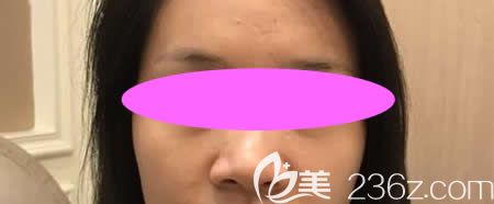 我沒(méi)在吉安天使做鼻綜合手術(shù)前的照片 我沒(méi)在吉安天使做鼻綜合手術(shù)前的照片