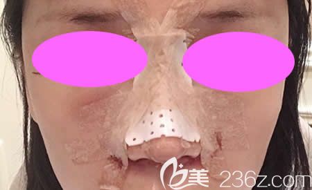 我找吉安天使王小輝做肋骨鼻綜合術(shù)后第1天 我找吉安天使王小輝做肋骨鼻綜合術(shù)后第1天