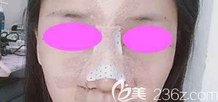 我找吉安天使王小輝做肋骨鼻綜合術(shù)后第3天效果 我找吉安天使王小輝做肋骨鼻綜合術(shù)后第3天效果