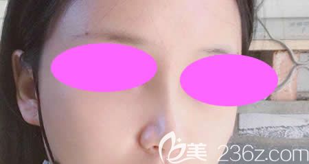 我找吉安天使王小輝做肋骨鼻綜合術(shù)后第28天效果 我找吉安天使王小輝做肋骨鼻綜合術(shù)后第28天效果