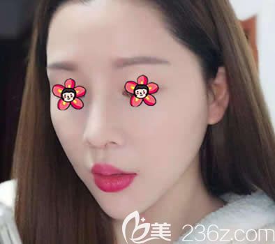 嘉興禾美整容醫(yī)院鼻綜合隆鼻案例 嘉興禾美整容醫(yī)院鼻綜合隆鼻案例