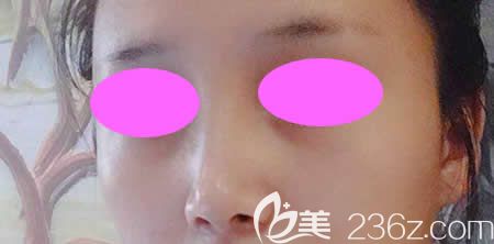 我找吉安天使王小輝做肋骨鼻綜合術(shù)后第46天效果 我找吉安天使王小輝做肋骨鼻綜合術(shù)后第46天效果