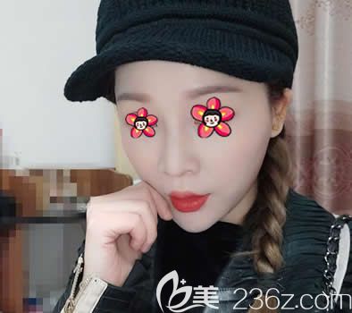 提前半個(gè)月電話預(yù)約終于約到嘉興禾美醫(yī)院曹海峰院長做了萬和硅膠假體隆鼻和耳軟骨墊鼻尖綜合手術(shù)