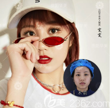 貴陽華美玻尿酸豐蘋果肌 貴陽華美玻尿酸豐蘋果肌