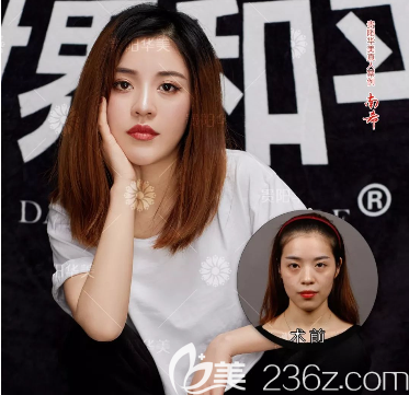 貴陽華美玻尿酸填充塑形案例 貴陽華美玻尿酸填充塑形案例