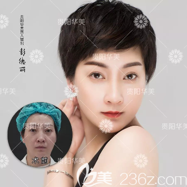 貴陽華美玻尿酸除皺效果 貴陽華美玻尿酸除皺效果