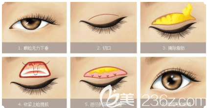 北京米蘭柏羽麗都上瞼下垂矯正手術(shù)示意圖