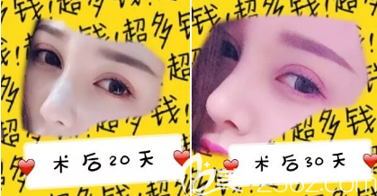 隆鼻術(shù)后20天和30天的照片