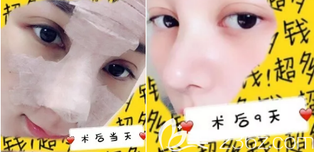 隆鼻術(shù)后9天和當(dāng)天的照片